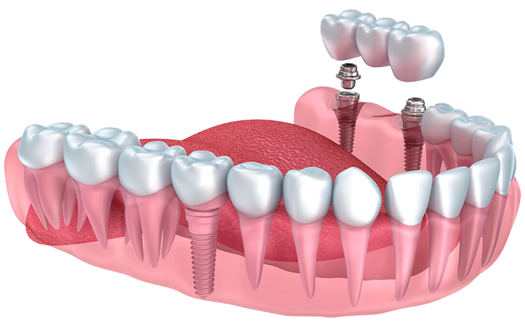 Ofertas en Implantes dentales